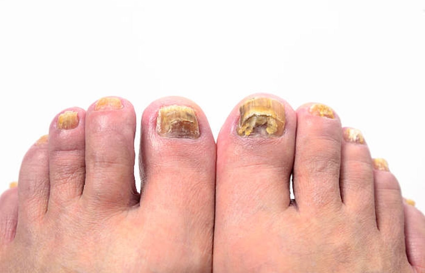 Fungal Nails